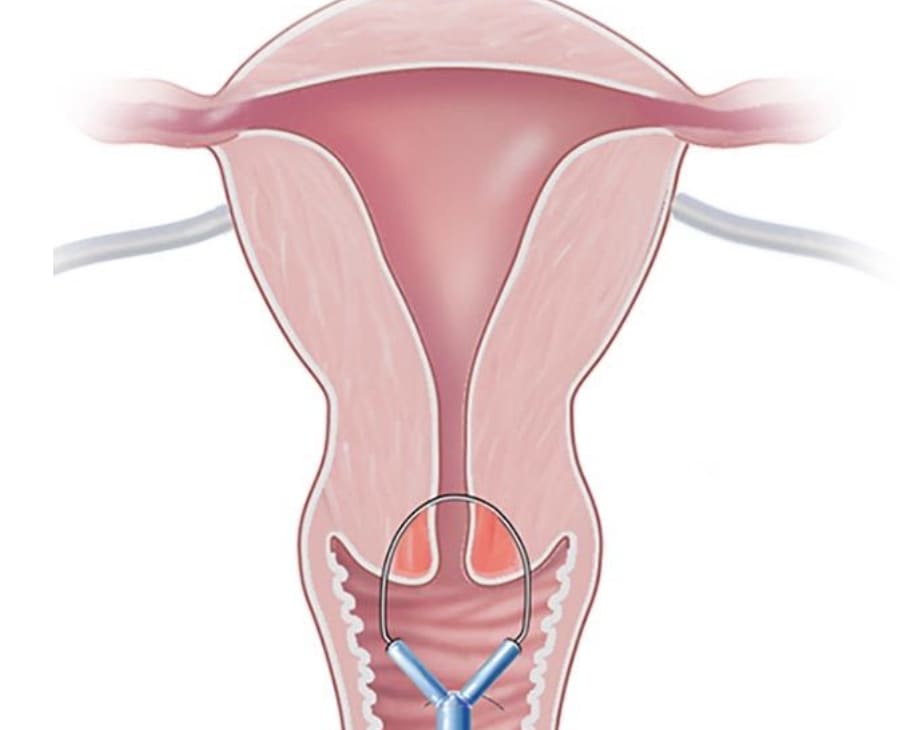 Electrocirugía cervical y esferolisis